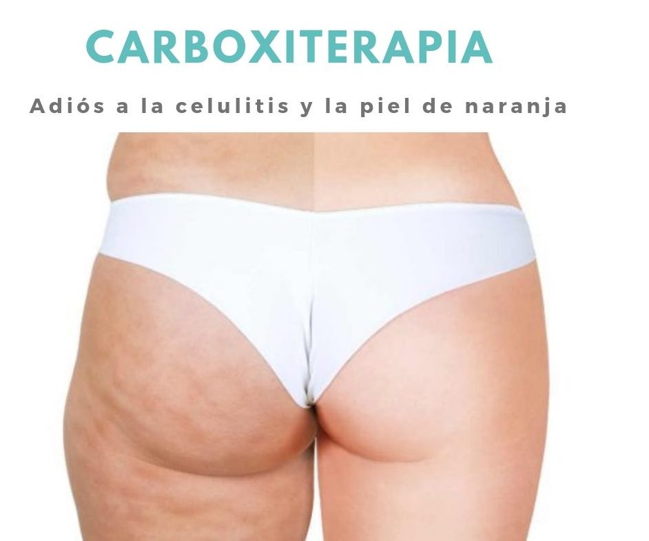 carboxiterapia