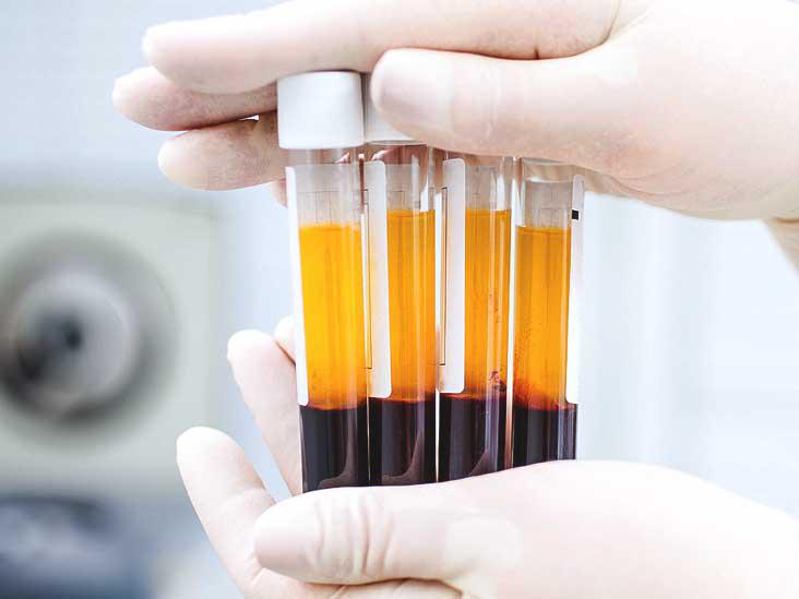plasma rico en plaquetas - tratamiento anti caída pelo - Esthetia clínica médica estética en Oliva, Valencia