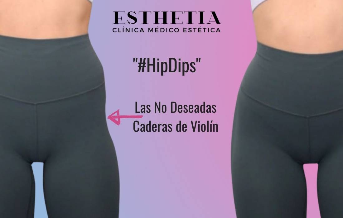 hip dip o cadera de violin correccion con rellenos dérmicos - Esthetia.es