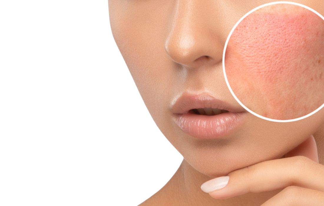 Redensificación facial - Acido hialuronico