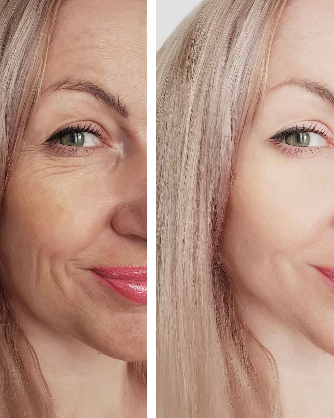 Eliminación de arrugas de expresión con toxina botulínica en Oliva